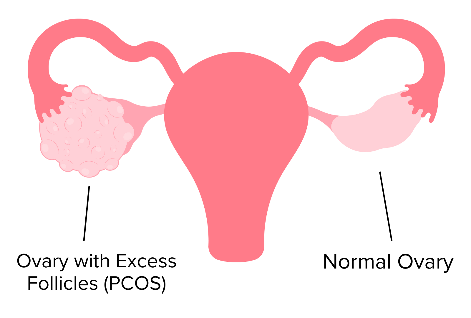 Ovary with Excess Follicles PCOS