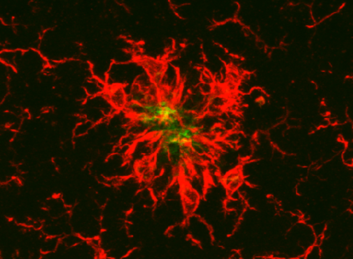 This is an image of amyloid plaque (green) surrounded by microglia (red)