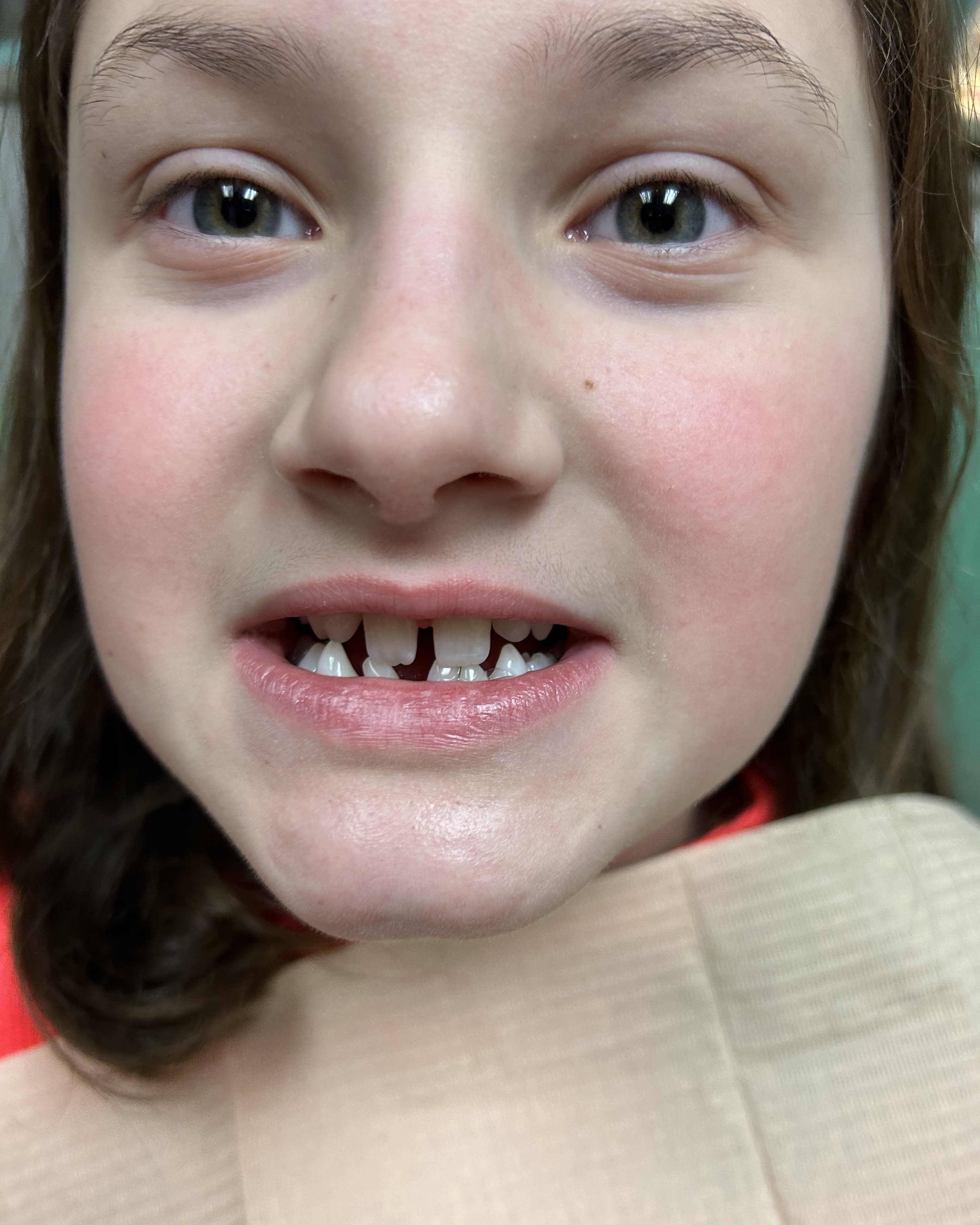 a close-up of a girl's mouth. The top teeth are small and have gaps between them. The bottom teeth are crooked. 