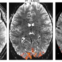 3 gray and white slices through the brain with a few areas highlighted in orange and yellow