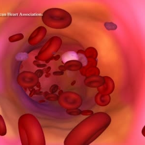 Vascular changes linked to dementia
