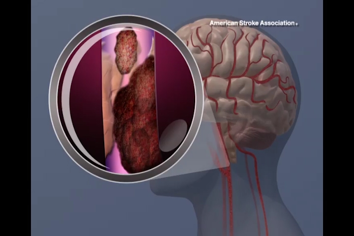 Blood clot breaking off in carotid artery