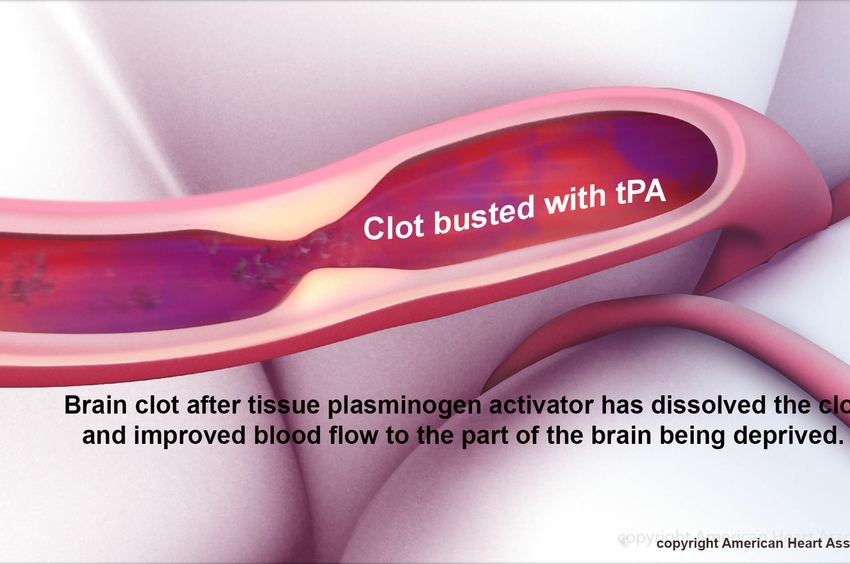 Cancer patients less likely to receive clotbusting drugs