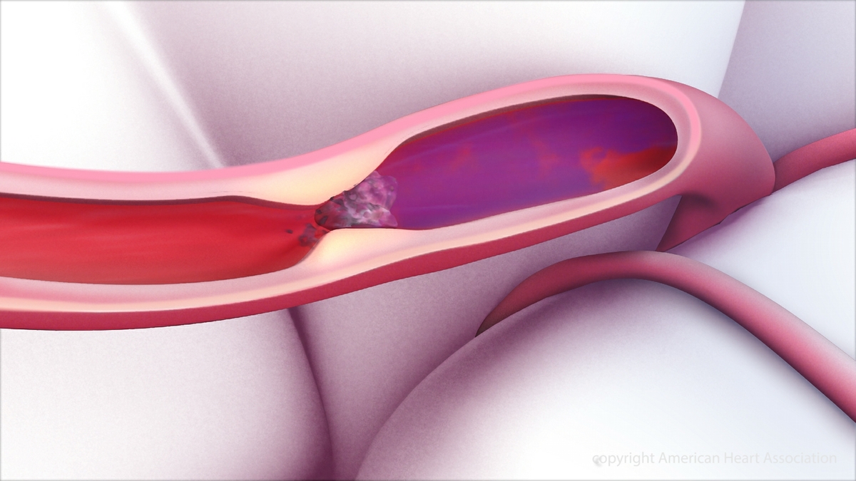 Blood Thinners Added to Clot-Busting Medication Did Not Improve Stroke Outcomes