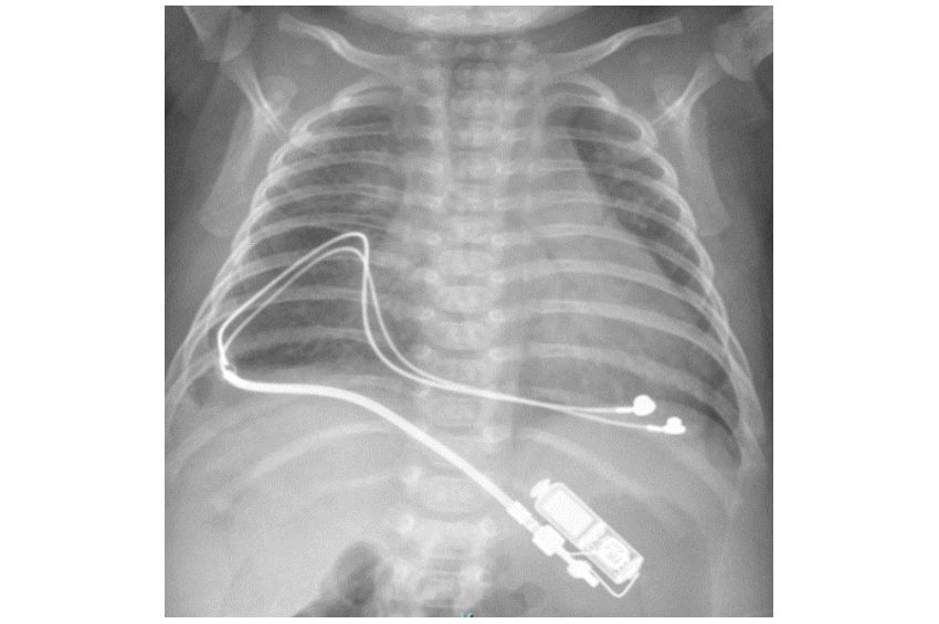 Photo pediatric pacemaker xray american heart association