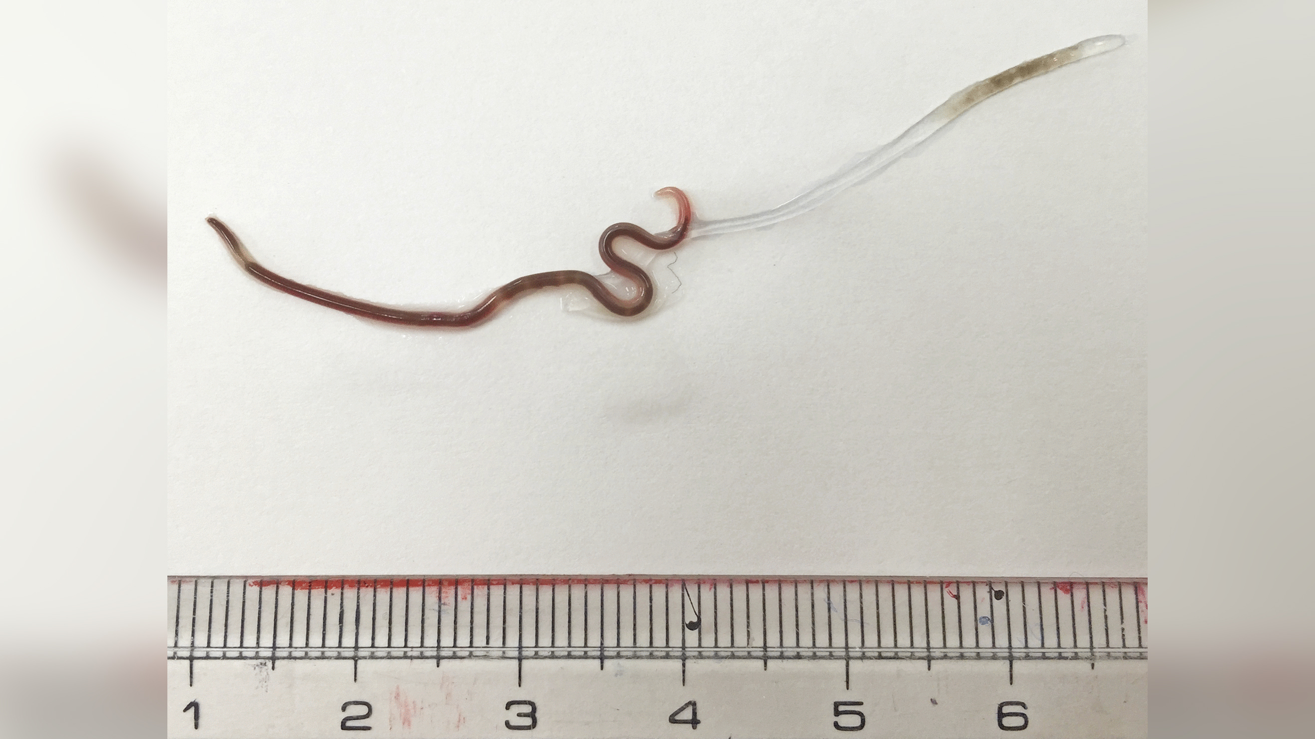 Doctors remove live worm from woman’s tonsil
