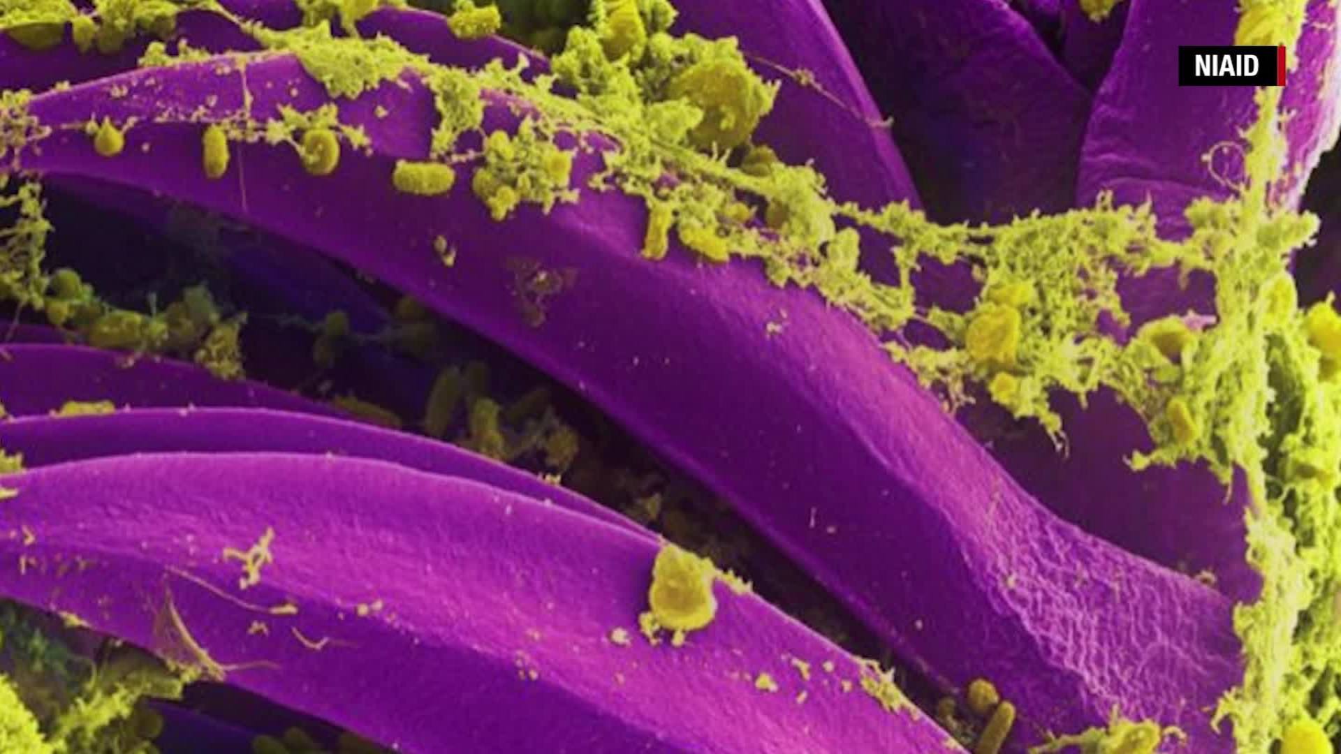 A New Mexico man has died from the state’s second reported case of plague this year