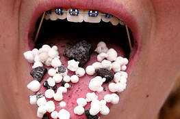 Braces & Dippin Dots by Barbara Hazen