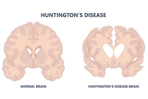 normal brain and Huntington’s disease brain comparing 3D illustration: Enter key opens full-screen view with caption; escape key exits full screen.