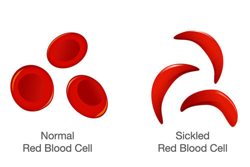 The difference of Normal red blood cell and sickle cell Illustration.: Enter key opens full-screen view with caption; escape key exits full screen.