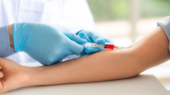 O exame de sangue é uma das formas de diagnosticar a esteatose hepática. Coleta de sangue sendo realizada.