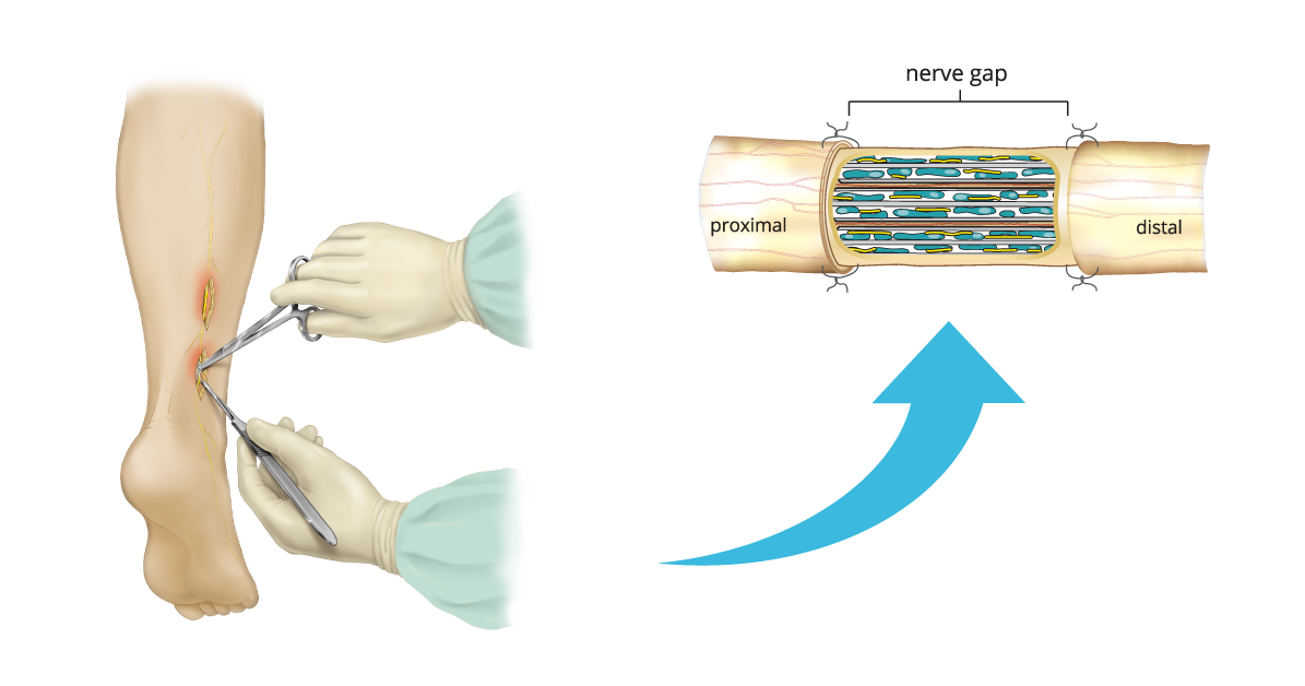Nerve Injuries & Treatment Options AxoGen, Inc. (AXGN)