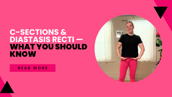 C-Sections & Diastasis Recti — What You Should Know