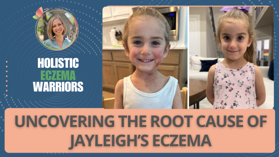 Uncovering the Root Causes of Jayleigh’s Eczema