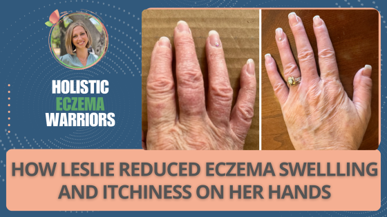 How Leslie Reduced Eczema Swelling and Itchiness on Her Hands