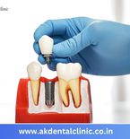 Advanced Dental Implants in Vile Parle, Mumbai | AK Dental Clinic
