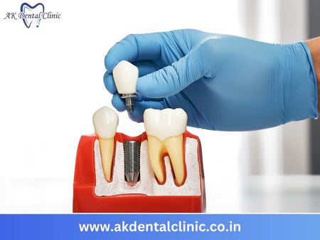 Advanced Dental Implants in Vile Parle, Mumbai | AK Dental Clinic