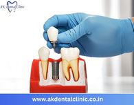Advanced Dental Implants in Vile Parle, Mumbai | AK Dental Clinic