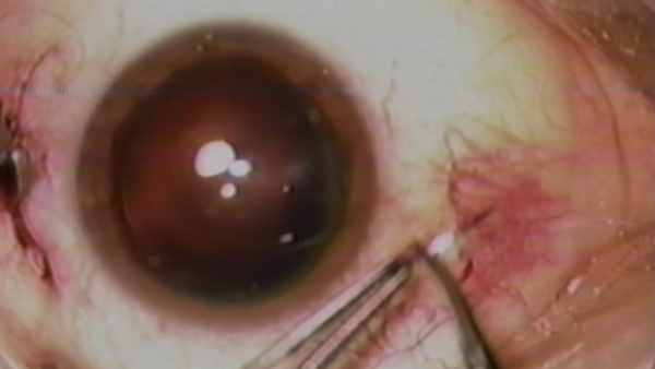 Swimming to the Macula