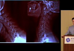 Craniocervical Fusion for Craniovertebral Instability
