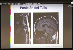 La Malformación de Chiari *en español*