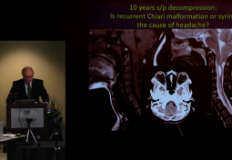 Headache Differential in the Chiari Malformation & Hypermobility Spectrum Patient