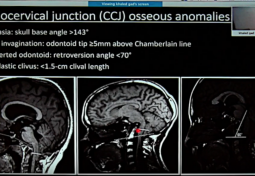 Syringohydromyelia in Patients with Chiari I Malformation: A Retrospective Analysis