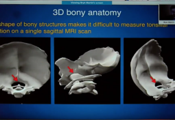 Quantitative MRI-Based Diagnostics for Chiari Malformation