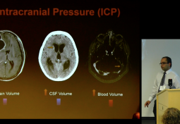CSF Pressure Reduction Results in Dynamic Changes in Optic Nerve Angle on MRI