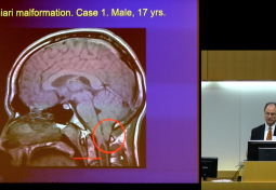 Cerebellar Cognitive Affective Syndrome: Anatomy & Implications for Chiari