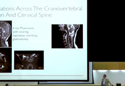 Round Table: Excellence in Neurosurgical Techniques in Chiari