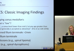 Imaging of Patient with Occult Tethered Cord Syndrome