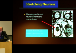 Neurosurgical Management of Hereditary Hypermobility