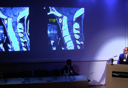 London Roundtable: Clinical case presentations of cranio-cervical instability