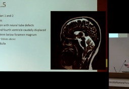 Chiari Malformation & Chiari 1.5: An Update