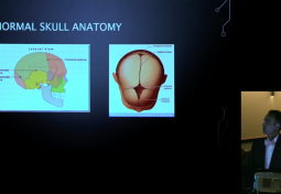 Craniosynostosis and Chiari Malformations