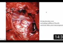Recurrent Syringomyelia After Chiari Decompression Surgery
