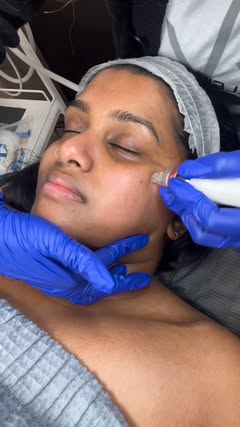 Skin is Skinning ✨

Hydro Dermabrasion uses a mix of saline solution and oxygen to gently remove dead skin. It focuses on hydrating the skin during this process. This hydration not only cleans the skin but also helps improve blood flow in the skin.

