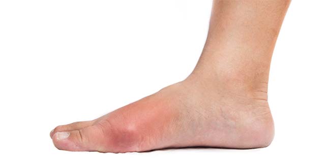 Jicht Het Pootje Symptomen Behandeling Op Natuurlijke Wijze