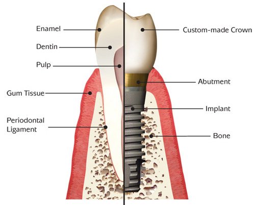 San Diego Dental Implants 