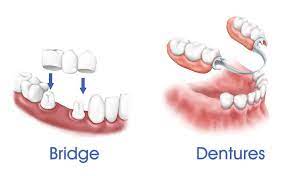Tooth Extraction And Implant Same Day Sugar Land