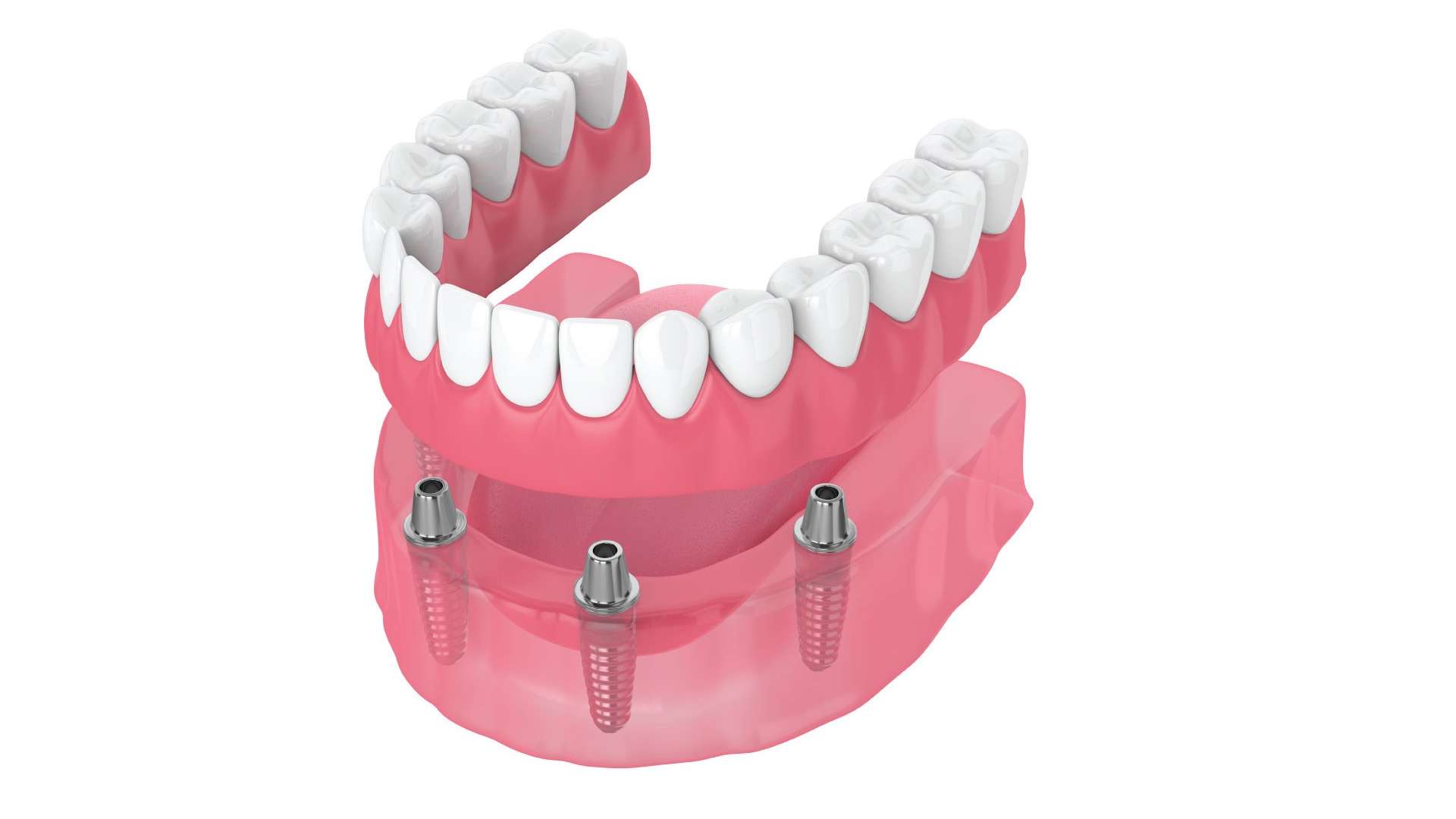 Best All on 4 dental implants Experts Sugar Land