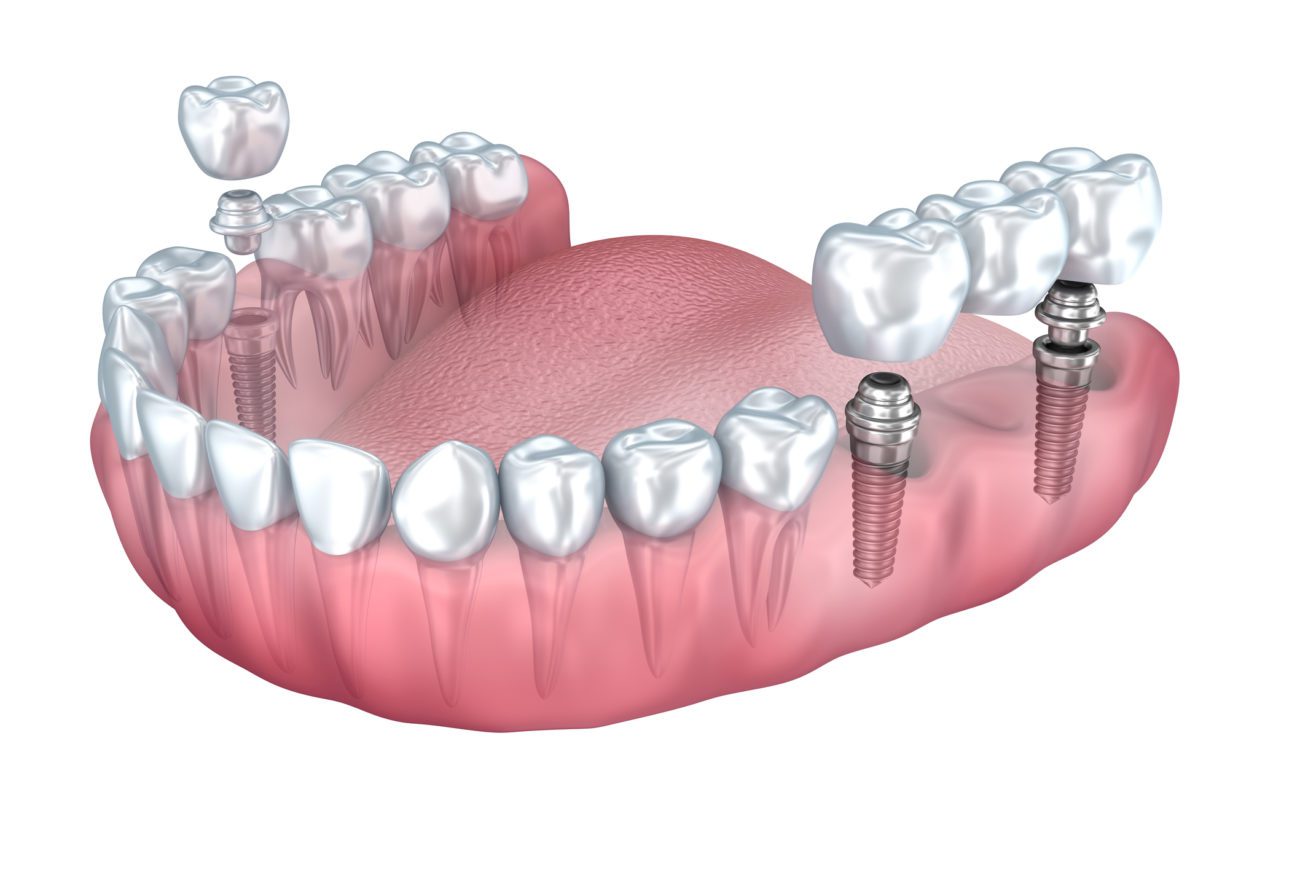 Single Dental Implant Cost 2022 Sugar Land