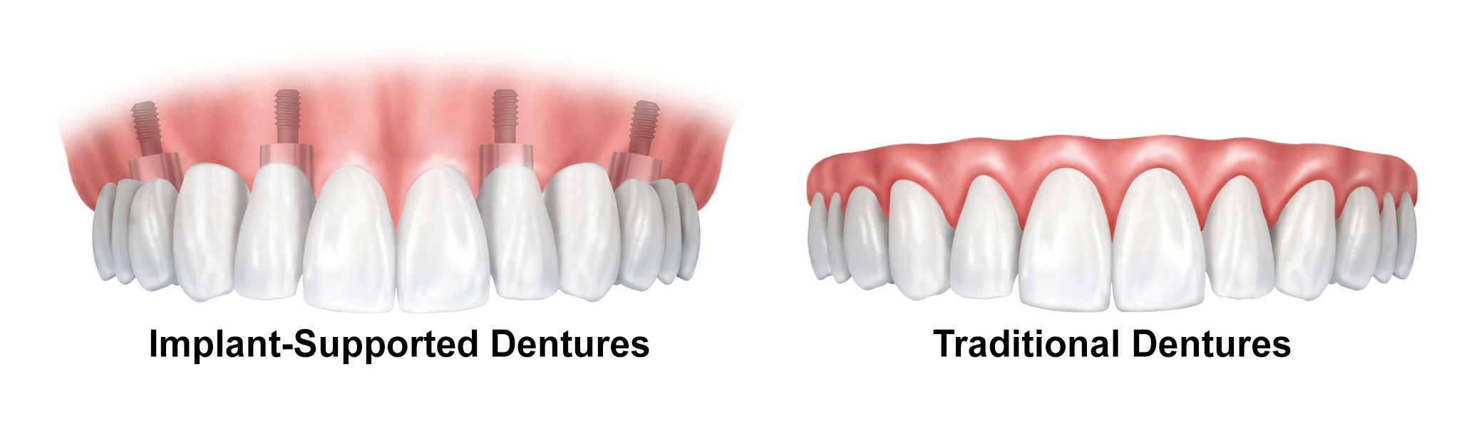 Dental Implants For Seniors Sugar Land