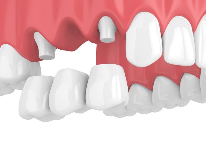 Sugar Land Dental Implants