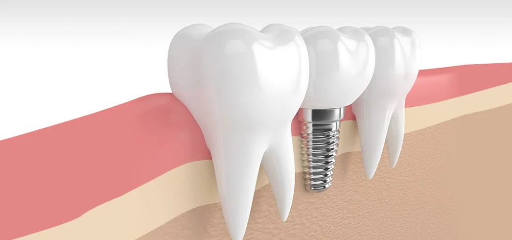 DENTAL CROWNS LOS ALGODONES MEXICO