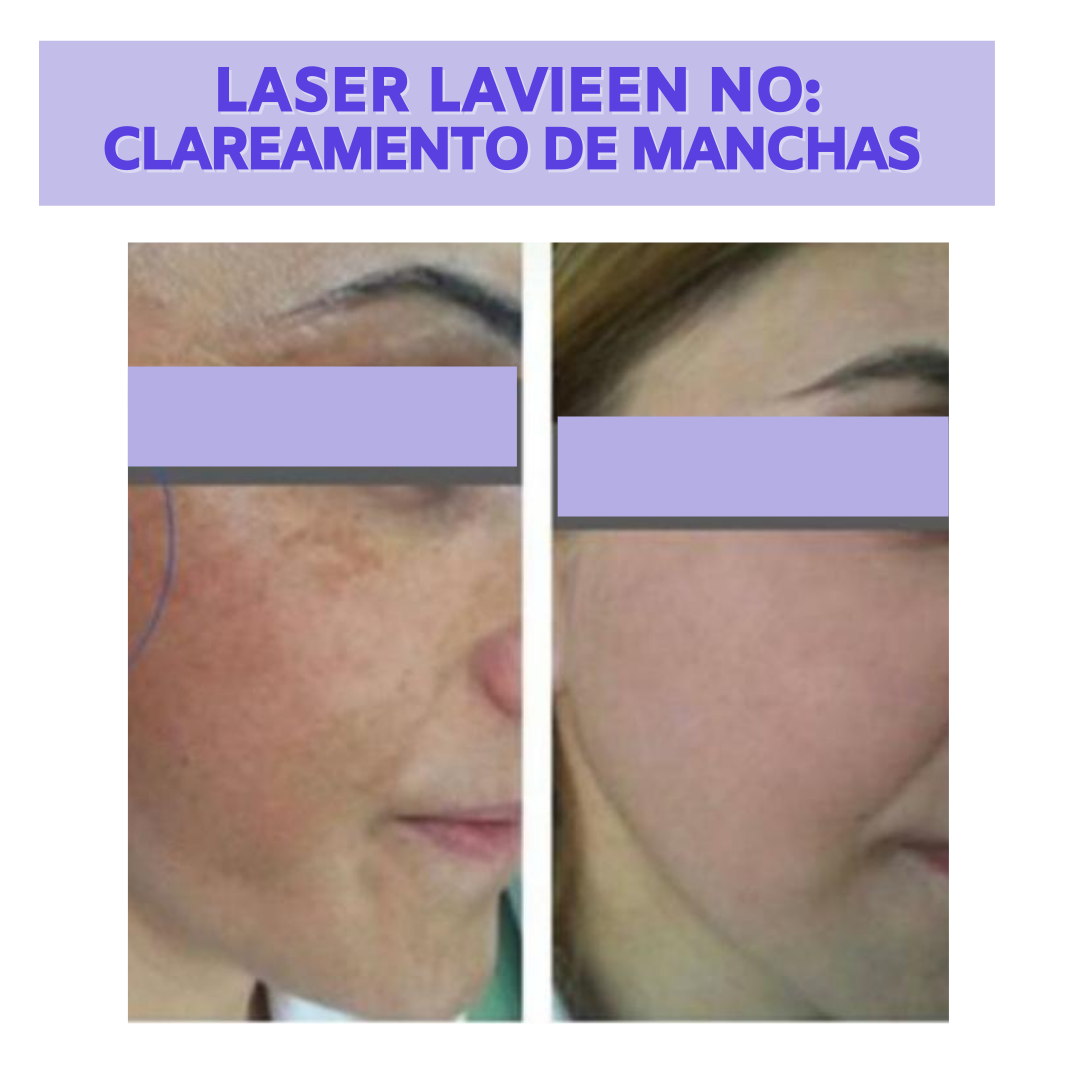 Laser Lavieen Spazzio