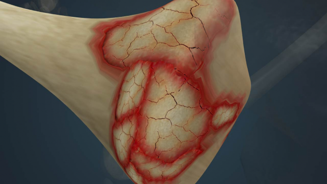 Total Knee Arthoplasty