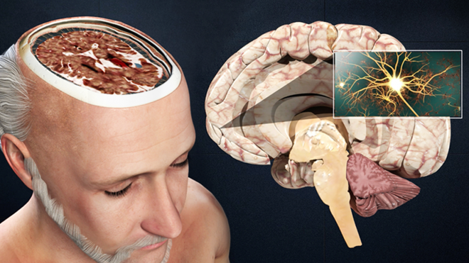 Has Your Client Suffered a Traumatic Brain Injury?