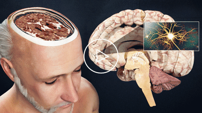 DK Global Case Feature Has Your Client Suffered A Traumatic Brain